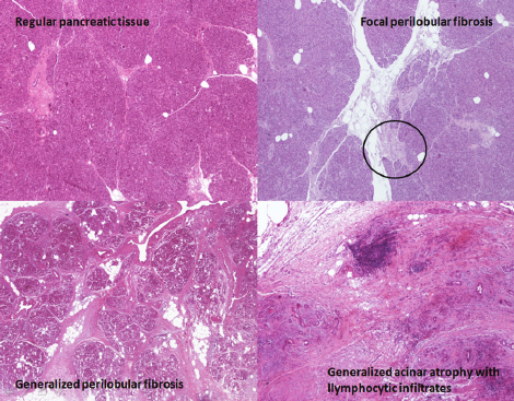pancreatic fibrosis