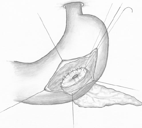 pancreatogastrostomy