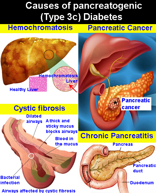 pancreatogenic