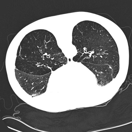 panlobular emphysema