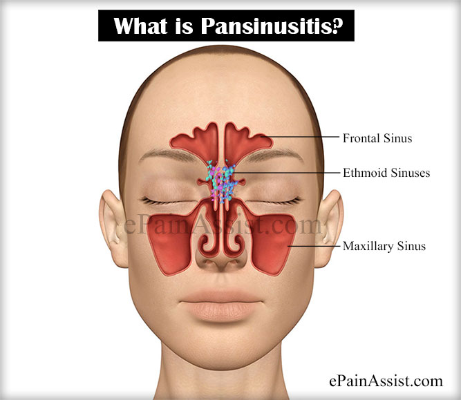 pansinusitis