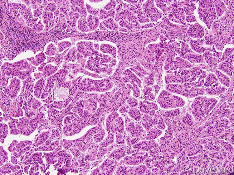 papillary adenocarcinoma