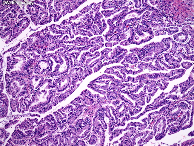papillary adenoma of large intestine