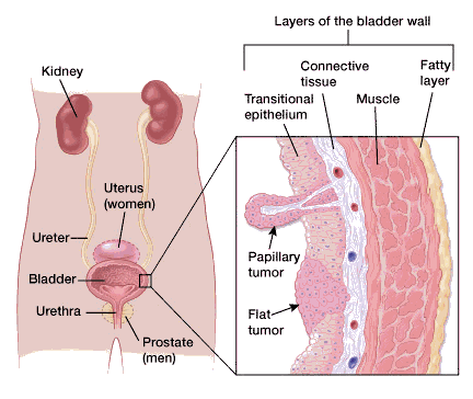 papillary tumor