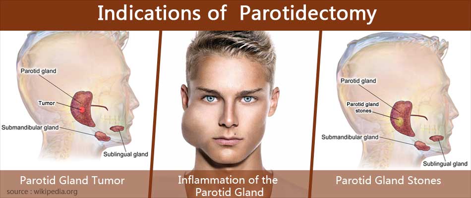 parotidectomy