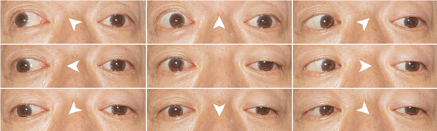 partial ophthalmoplegia