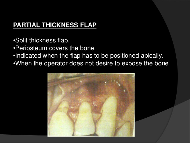 partial-thickness flap