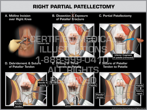 patellectomy
