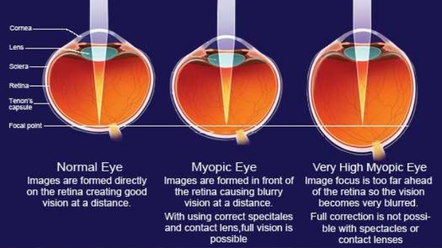 pathologic myopia