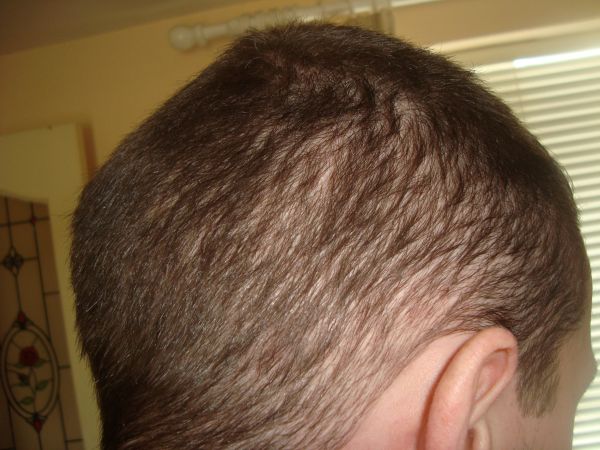 patterned alopecia