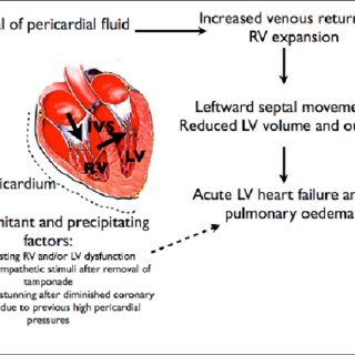 pericardial decompression