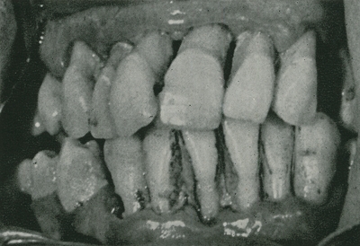 periodontoclasia