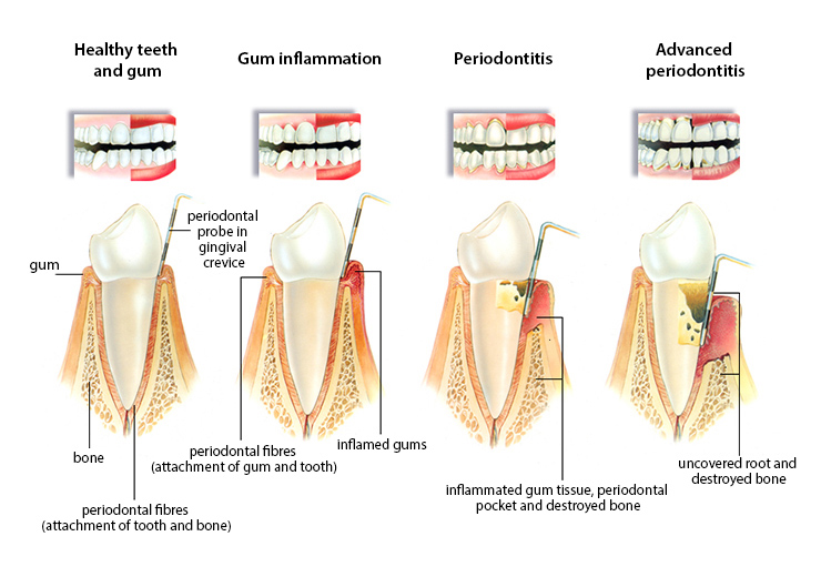 periodontosis
