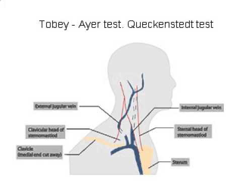 queckenstedt-stookey test