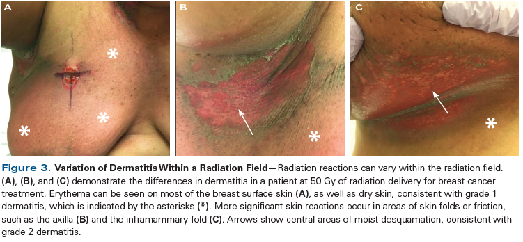 radiation dermatitis