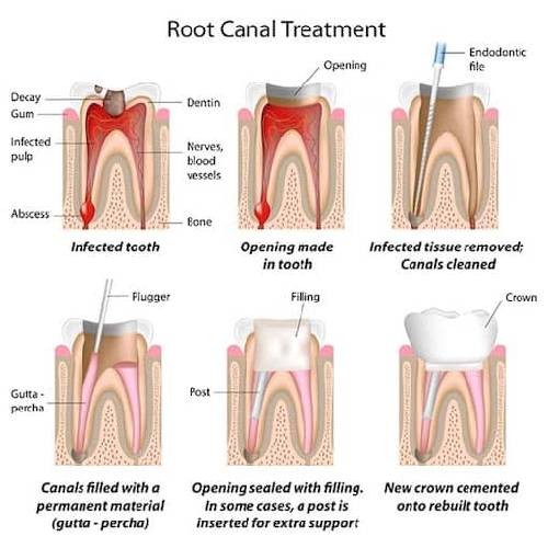 root-canal therapy