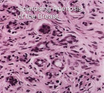 sclerosing adenosis