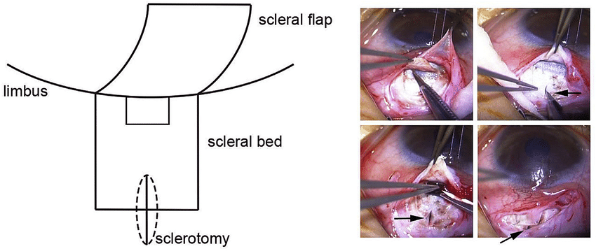 sclerotomy