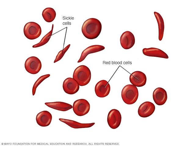 sickle-cell anaemia