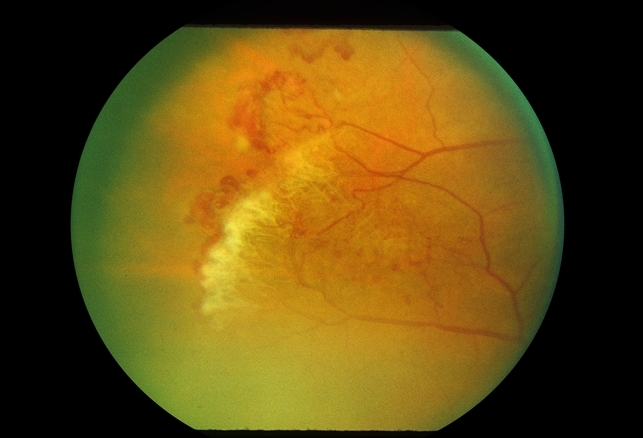 sickle cell retinopathy