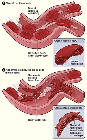 sickle cell syndrome