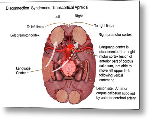 transcortical apraxia