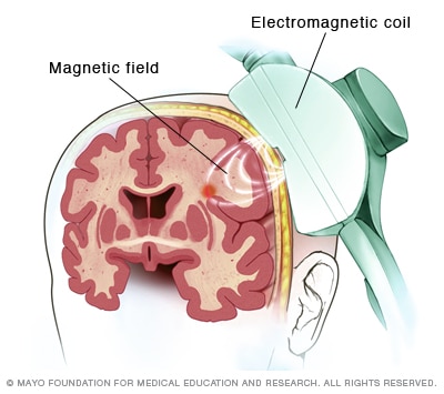 transcranial magnetic stimulation