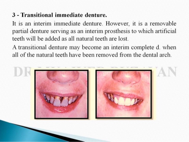 transitional denture