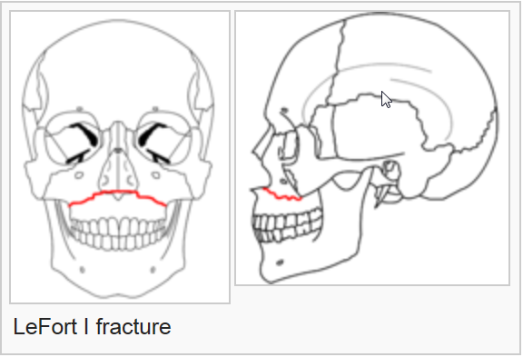 transverse facial fracture