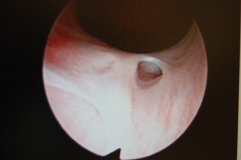 uretercystoscope