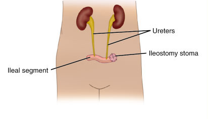 ureterocolostomy