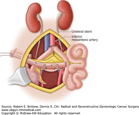 ureteroenterostomy
