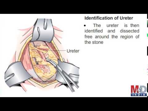ureterolithotomy
