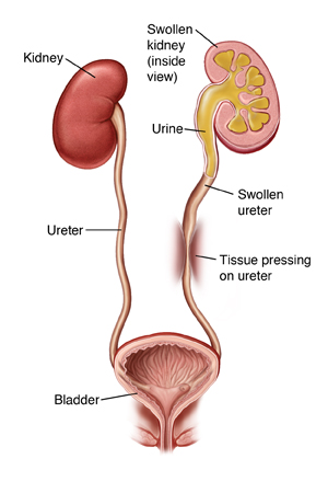 ureterolysis