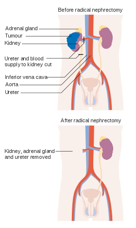 ureteronephrectomy