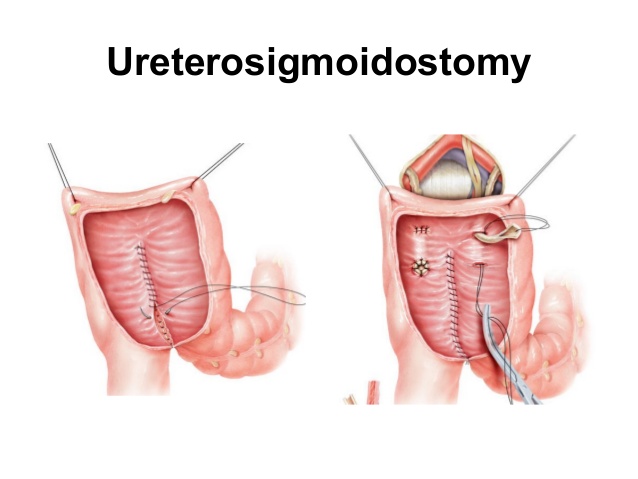 ureterosigmoidostomy