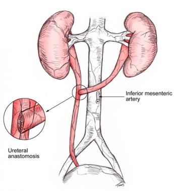 ureteroureterostomy