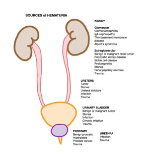 urethral hematuria