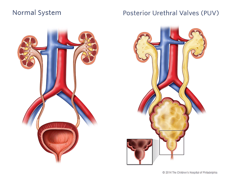 urethral valve