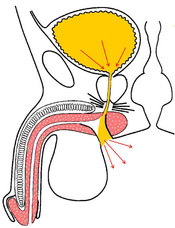 urethrostomy