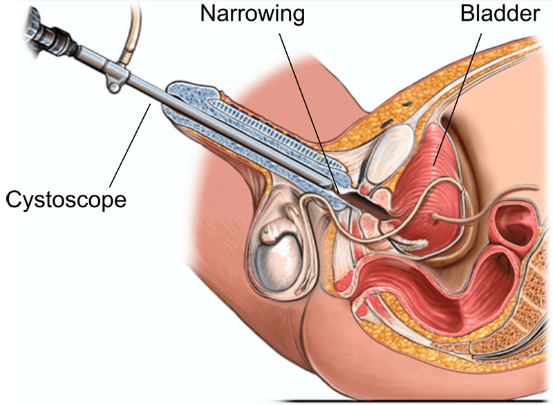 urethrotomy