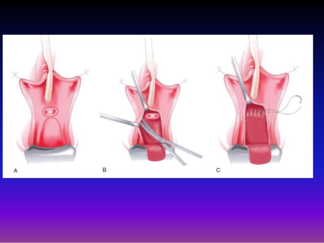 urethrovaginal fistula
