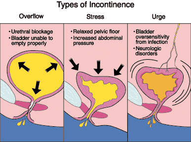urgency incontinence