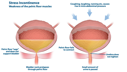 urinary stress incontinence