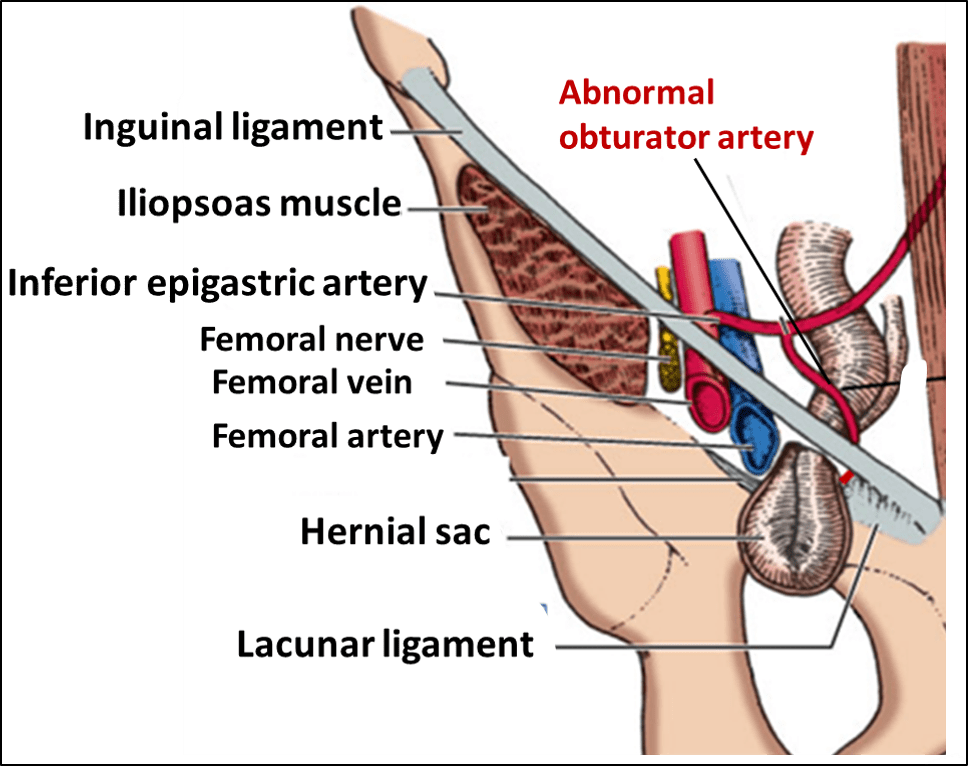 accessory obturator artery