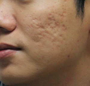 acne indurata