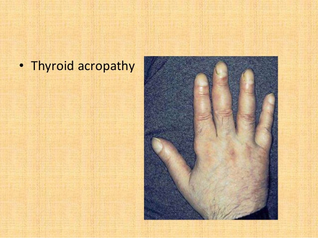 acropathy