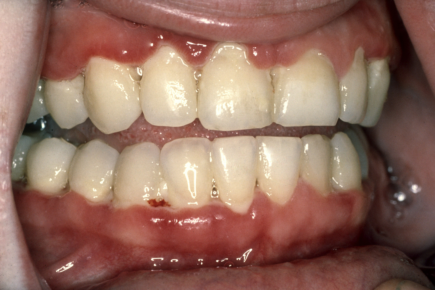 牙龈高度不一致，牙齿缺失，畸形过小牙，联合修复病例分享_谭敬宇_住院医师_爱问健康