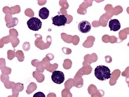 basophilic leukemia