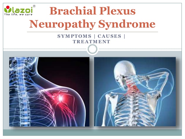 brachial plexus neuropathy